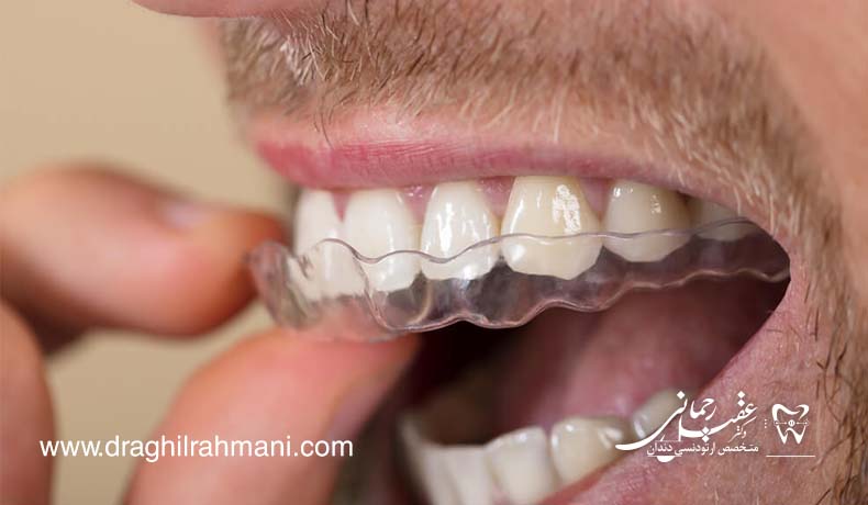 اینویزیلاین اینویزیلاین